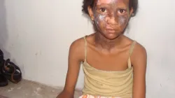 Nicht nur radikale Muslime verfolgen Christen: Dieses Mädchen erlitt Brandverletzungen bei einem Anschlag durch extremistische Hindus auf das Haus ihrer Familie im indischen Bundesstaat Orissa im April 2008.  / All India Christian Council via Wikimedia (CC BY-SA 3.0)